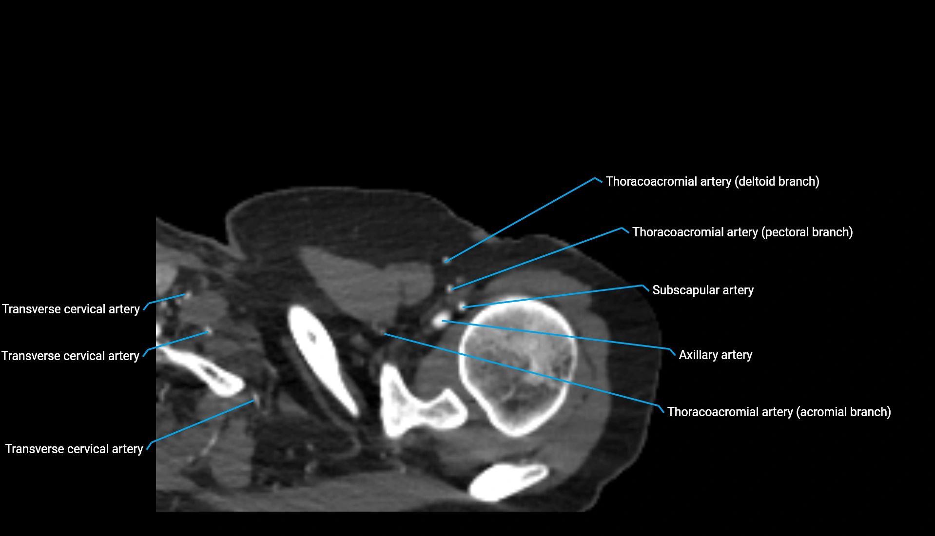 CTA upper limb axial cross sectional anatomy labelled image 326 (1).webp